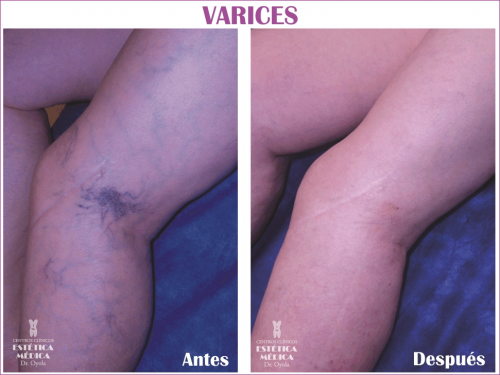 Eliminaci�n varices 03